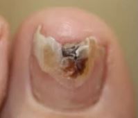 nail discoloration